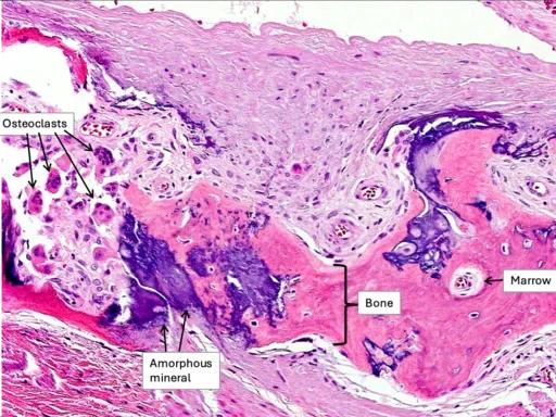 Mineralization in vascular tissue.