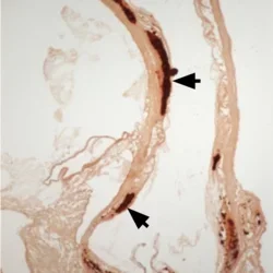 Atherosclerotic calcification up close.