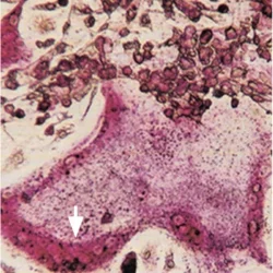 Lipids and calcification process illustrated in detail.