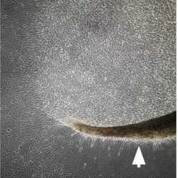 Formation of spontaneous calcific nodule in gray and white.